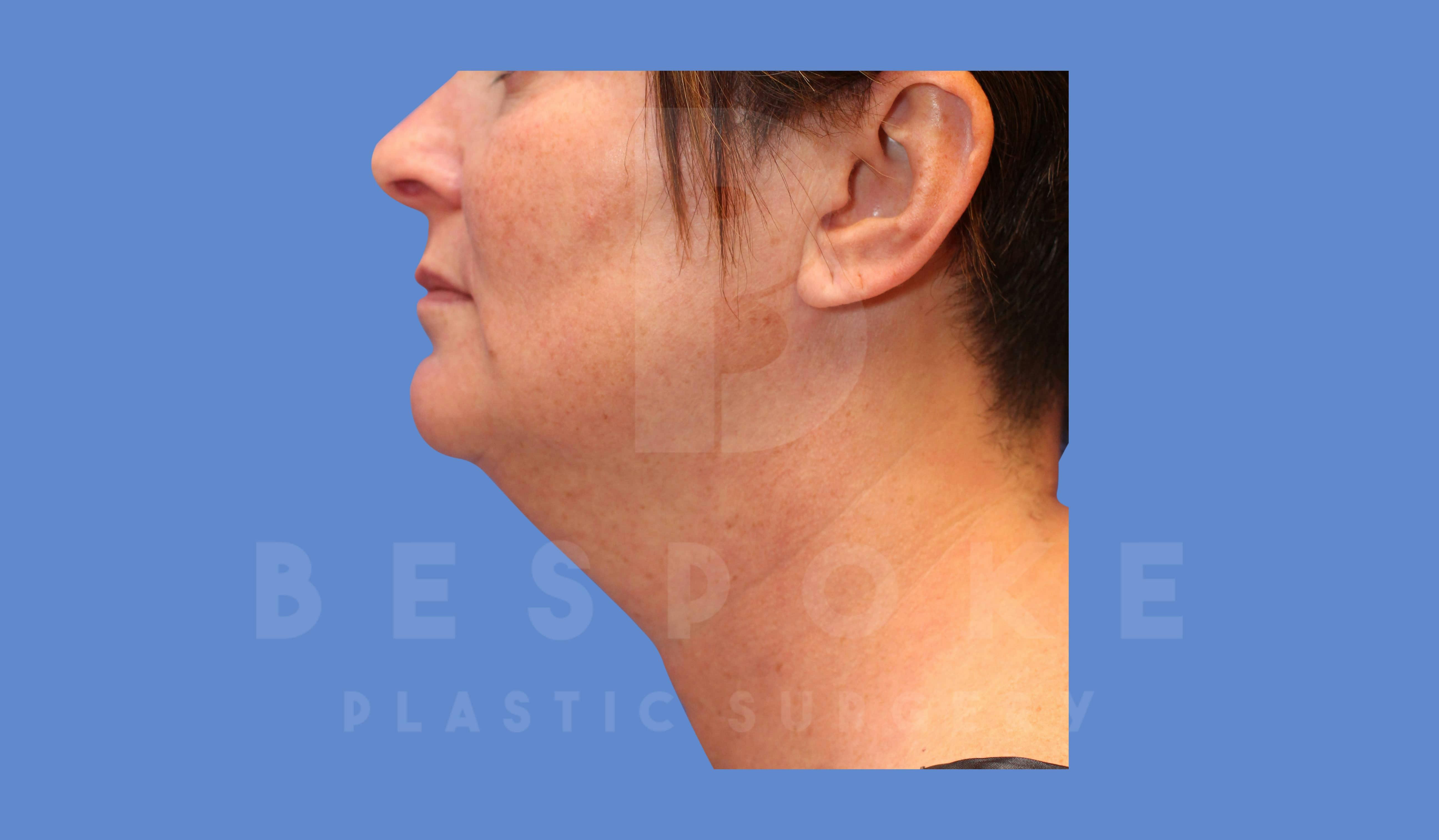 Liposuction Before & After Gallery - Patient 144208087 - Image 1