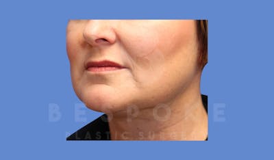 Liposuction Before & After Gallery - Patient 144208087 - Image 4