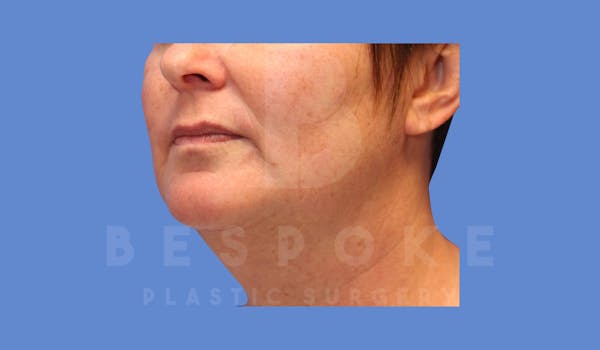 Liposuction Before & After Gallery - Patient 144208087 - Image 3