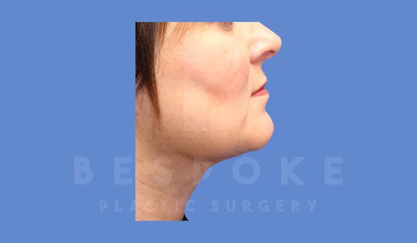 Liposuction Before & After Gallery - Patient 144208087 - Image 6