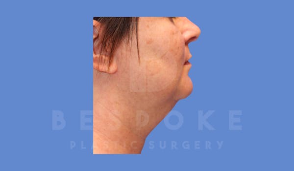 Liposuction Before & After Gallery - Patient 144208087 - Image 5