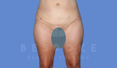 Liposuction Before & After Gallery - Patient 144208086 - Image 2