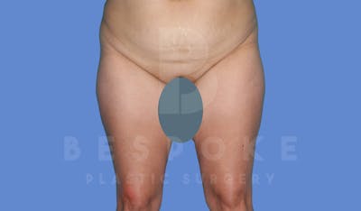 Liposuction Before & After Gallery - Patient 144208086 - Image 1