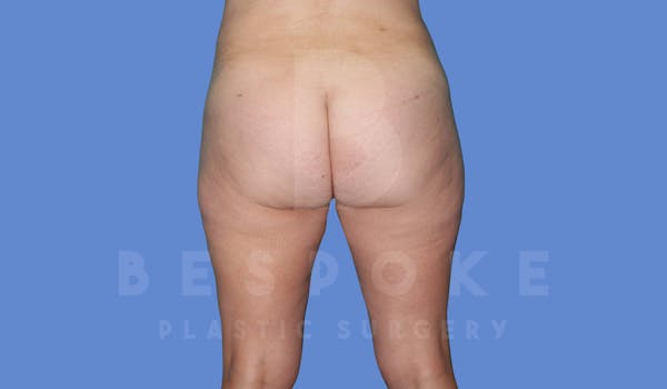 Liposuction Before & After Gallery - Patient 144208086 - Image 4