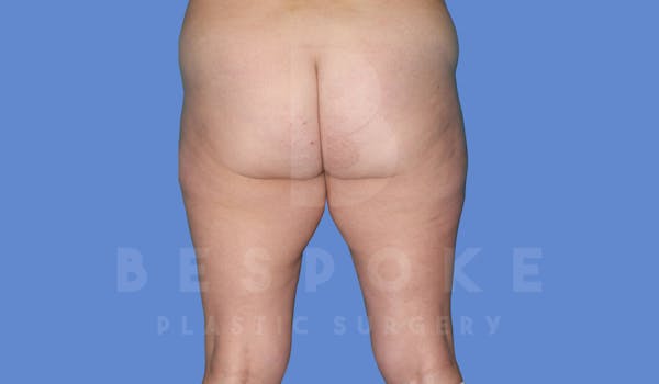 Liposuction Before & After Gallery - Patient 144208086 - Image 3