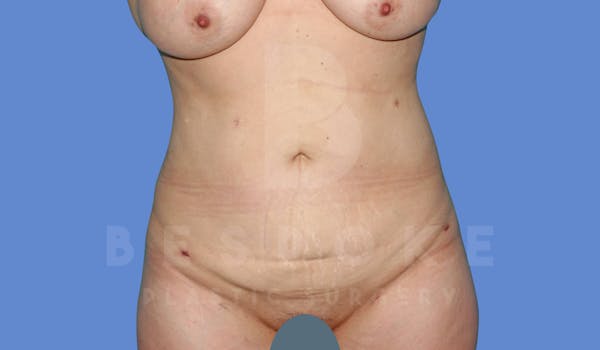 Liposuction Before & After Gallery - Patient 144208085 - Image 2