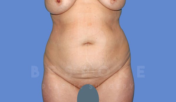Liposuction Before & After Gallery - Patient 144208085 - Image 1