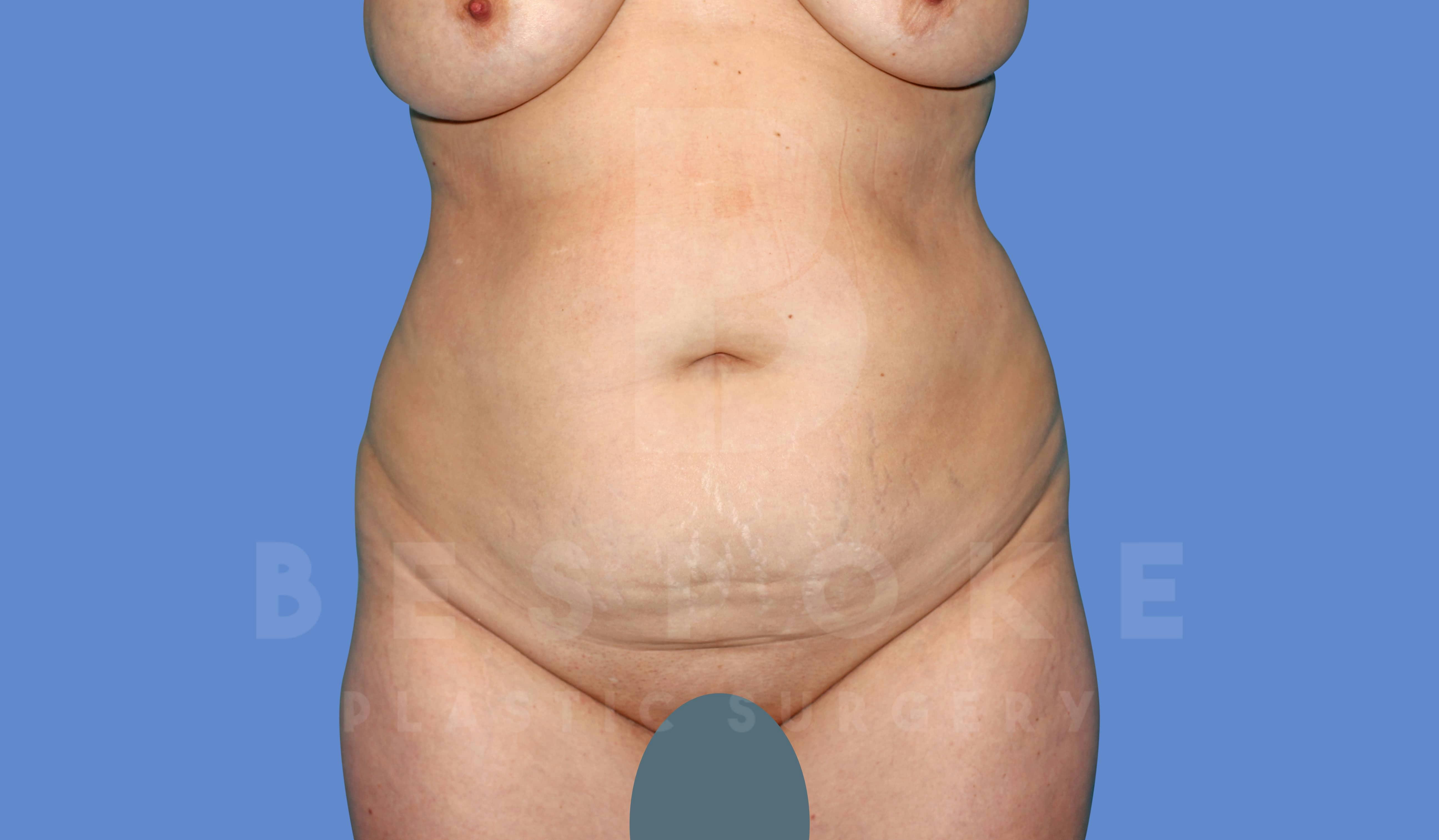Liposuction Before & After Gallery - Patient 144208085 - Image 1