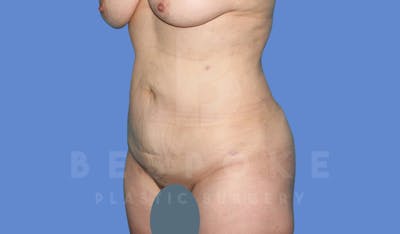 Liposuction Before & After Gallery - Patient 144208085 - Image 4