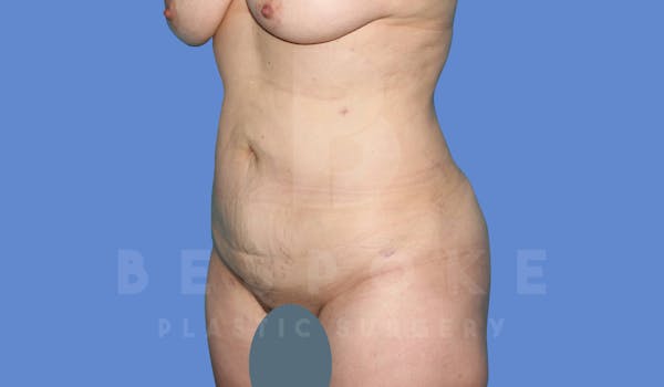 Liposuction Before & After Gallery - Patient 144208085 - Image 4