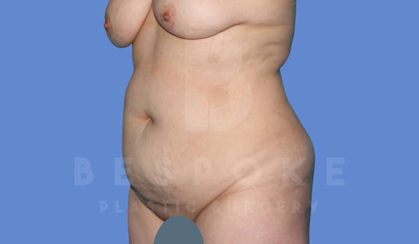 Liposuction Before & After Gallery - Patient 144208085 - Image 3