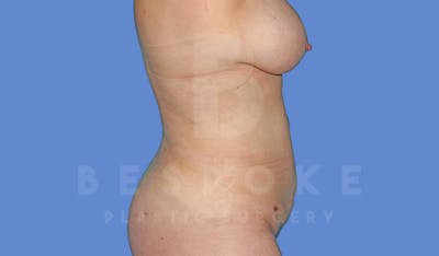 Liposuction Before & After Gallery - Patient 144208085 - Image 6