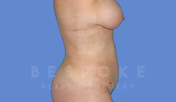 Liposuction Before & After Gallery - Patient 144208085 - Image 6