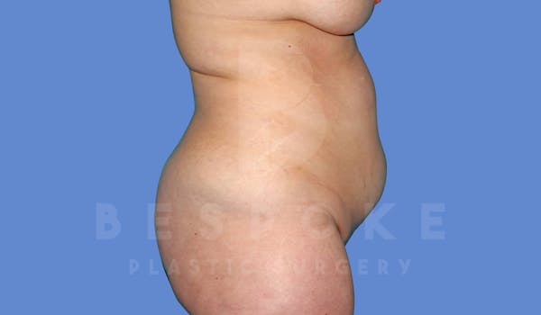 Liposuction Before & After Gallery - Patient 144208085 - Image 5