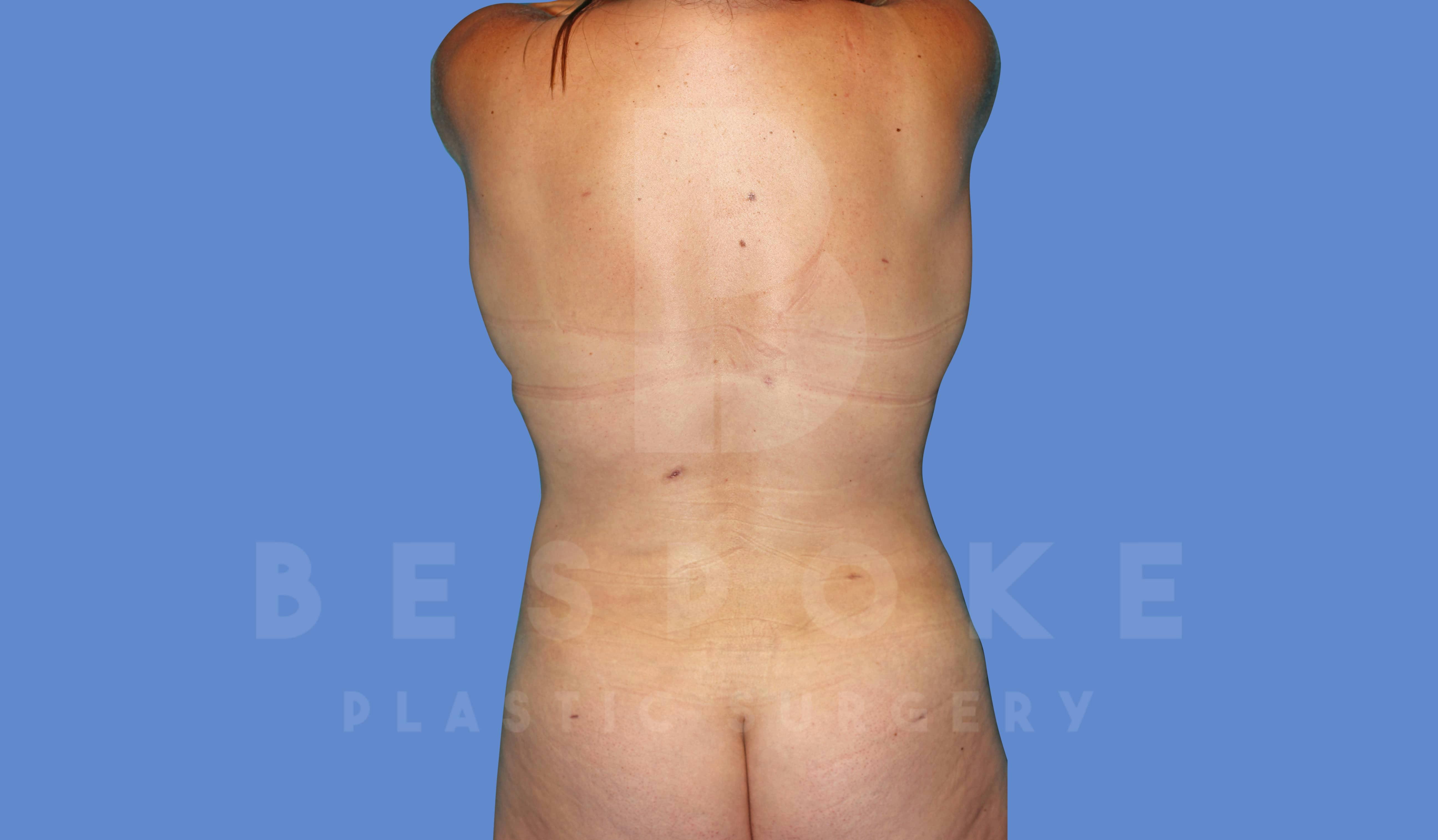 Liposuction Before & After Gallery - Patient 144208084 - Image 2