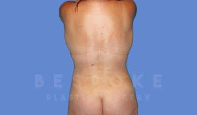 Liposuction Before & After Gallery - Patient 144208084 - Image 2