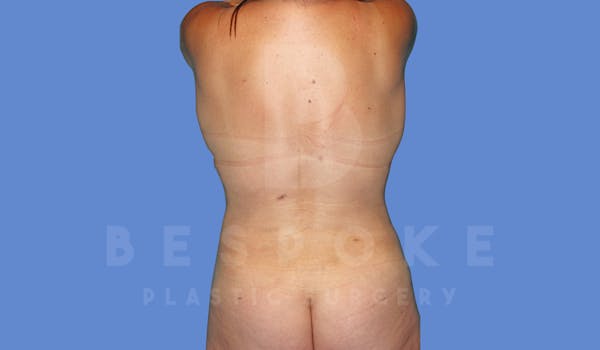 Liposuction Before & After Gallery - Patient 144208084 - Image 2