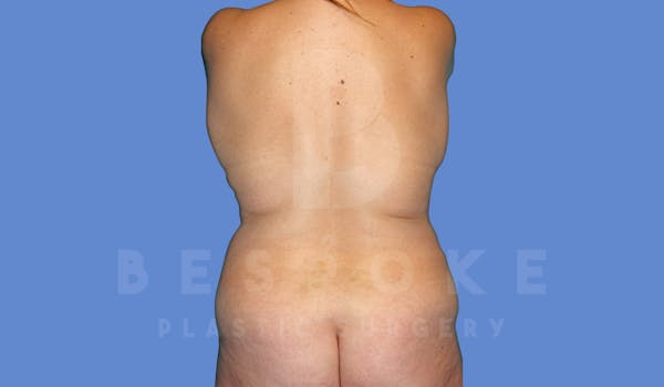 Liposuction Before & After Gallery - Patient 144208084 - Image 1