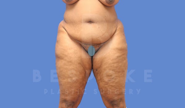 Liposuction Before & After Gallery - Patient 144208083 - Image 1