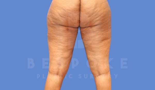 Liposuction Before & After Gallery - Patient 144208083 - Image 4