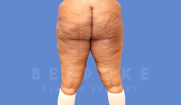 Liposuction Before & After Gallery - Patient 144208083 - Image 3