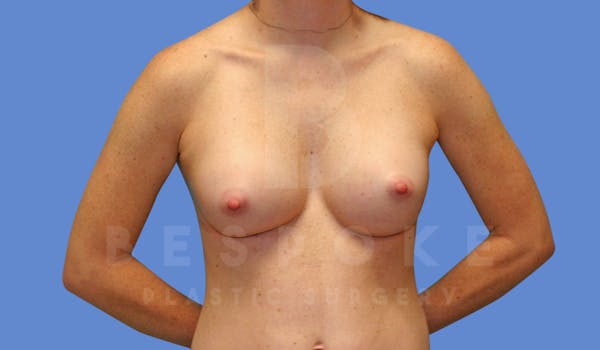 Breast Augmentation Before & After Gallery - Patient 144208248 - Image 2