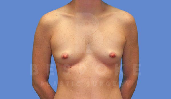 Breast Augmentation Before & After Gallery - Patient 144208248 - Image 1