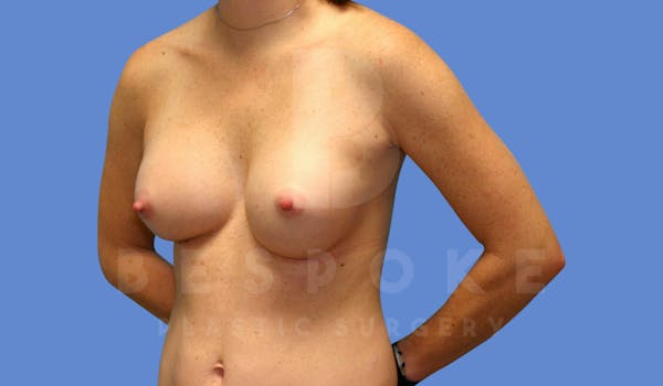 Breast Augmentation Before & After Gallery - Patient 144208248 - Image 4