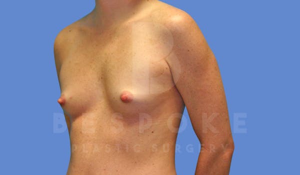 Breast Augmentation Before & After Gallery - Patient 144208248 - Image 3
