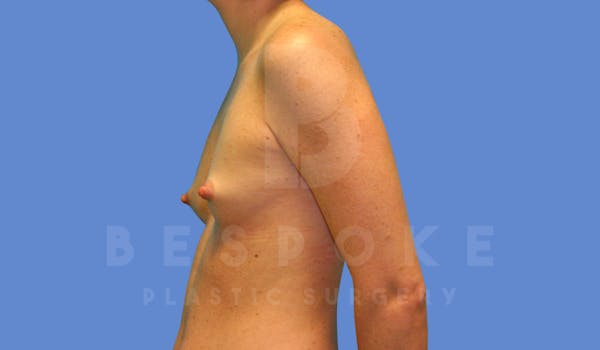 Breast Augmentation Before & After Gallery - Patient 144208248 - Image 5