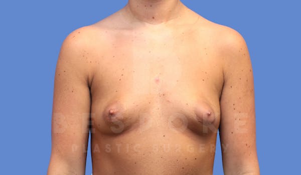 Breast Augmentation Before & After Gallery - Patient 144208247 - Image 1