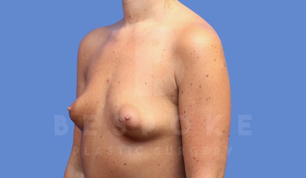 Breast Augmentation Before & After Gallery - Patient 144208247 - Image 3