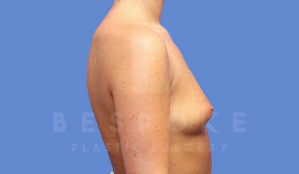 Breast Augmentation Before & After Gallery - Patient 144208247 - Image 5
