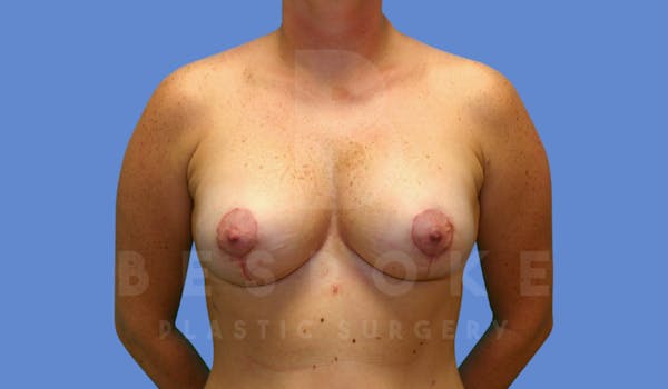 Breast Lift With Implants Before & After Gallery - Patient 144208255 - Image 2