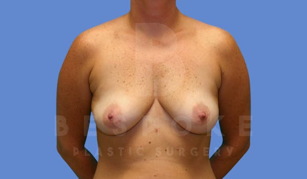 Breast Lift With Implants Before & After Gallery - Patient 144208255 - Image 1