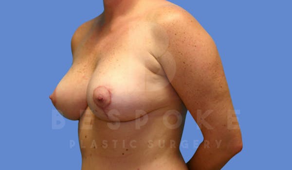 Breast Lift With Implants Before & After Gallery - Patient 144208255 - Image 4