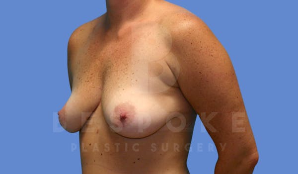Breast Lift With Implants Before & After Gallery - Patient 144208255 - Image 3