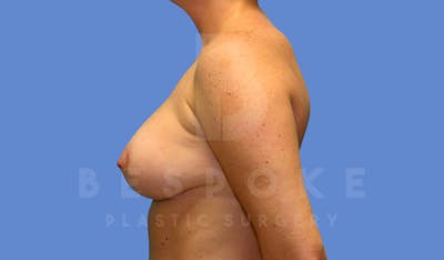 Breast Lift With Implants Before & After Gallery - Patient 144208255 - Image 6