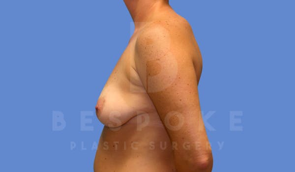 Breast Lift With Implants Before & After Gallery - Patient 144208255 - Image 5