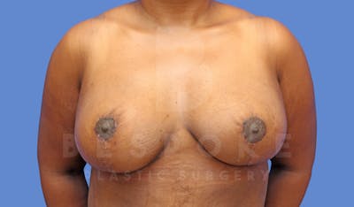 Breast Reduction Before & After Gallery - Patient 144208260 - Image 2