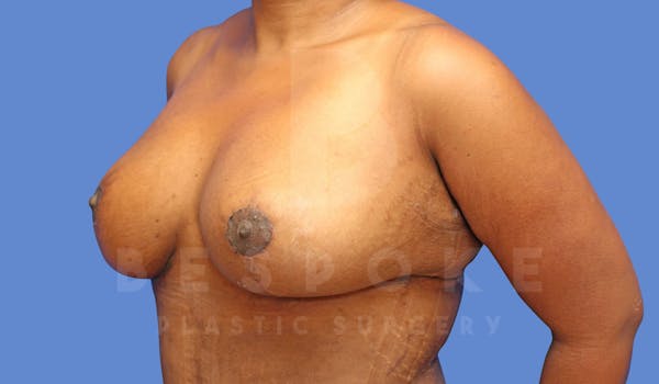 Breast Reduction Before & After Gallery - Patient 144208260 - Image 4