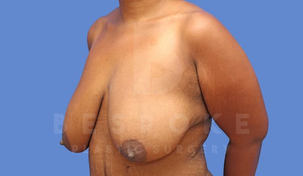 Breast Reduction Before & After Gallery - Patient 144208260 - Image 3