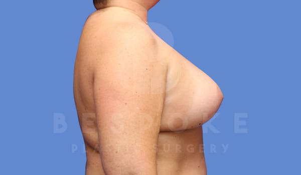 Breast Revision Surgery Before & After Gallery - Patient 144208304 - Image 4