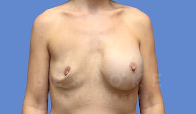 Breast Revision Surgery Before & After Gallery - Patient 144208303 - Image 1