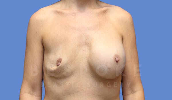 Breast Revision Surgery Before & After Gallery - Patient 144208303 - Image 1