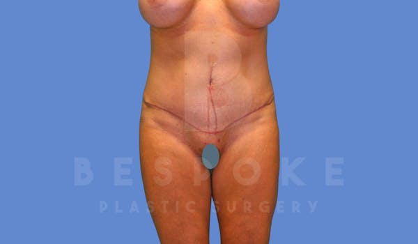 Tummy Tuck Before & After Gallery - Patient 144270071 - Image 2