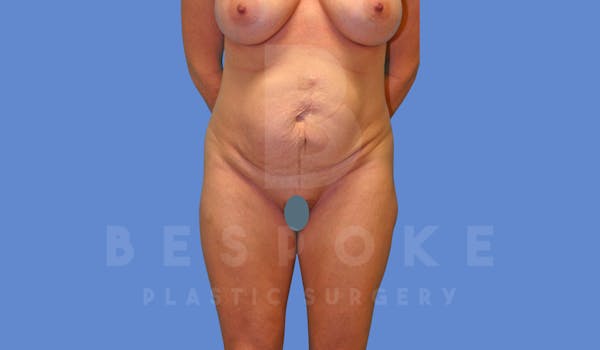 Tummy Tuck Before & After Gallery - Patient 144270071 - Image 1