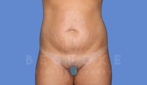 Charlotte NC Before & After Tummy Tuck