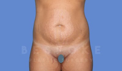 Tummy Tuck Before & After Gallery - Patient 144270070 - Image 1