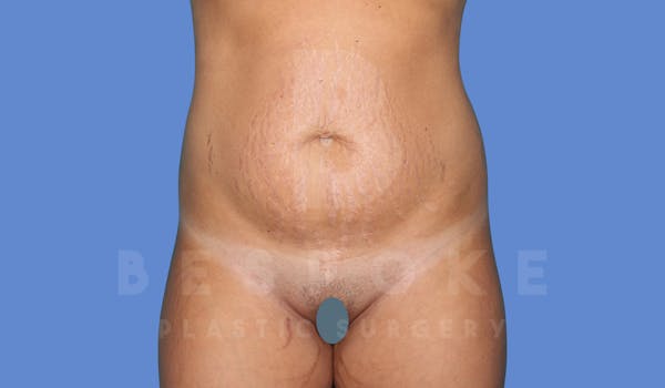 Tummy Tuck Before & After Gallery - Patient 144270070 - Image 1